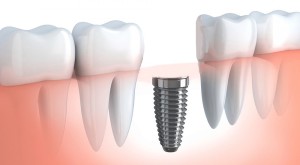 impianti dentali certificati